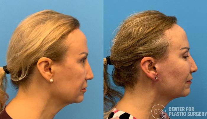 Facelift Case 408 Before & After Right Side | Chevy Chase & Annandale, Washington D.C. Metropolitan Area | Center for Plastic Surgery