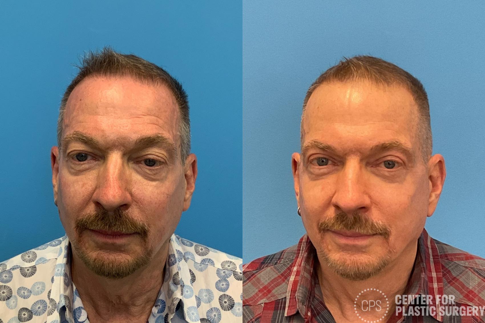 Facelift for Men Case 411 Before & After Front | Chevy Chase & Annandale, Washington D.C. Metropolitan Area | Center for Plastic Surgery