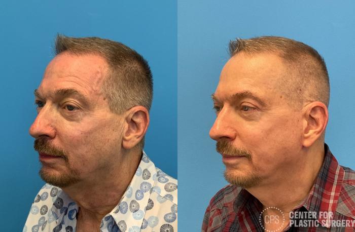 Facelift for Men Case 411 Before & After Left Oblique | Chevy Chase & Annandale, Washington D.C. Metropolitan Area | Center for Plastic Surgery