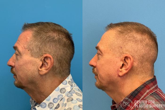 Facelift for Men Case 411 Before & After Left Side | Chevy Chase & Annandale, Washington D.C. Metropolitan Area | Center for Plastic Surgery