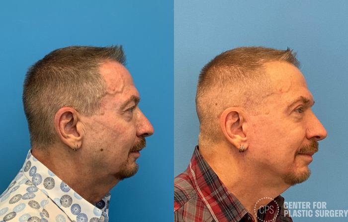 Facelift for Men Case 411 Before & After Right Side | Chevy Chase & Annandale, Washington D.C. Metropolitan Area | Center for Plastic Surgery