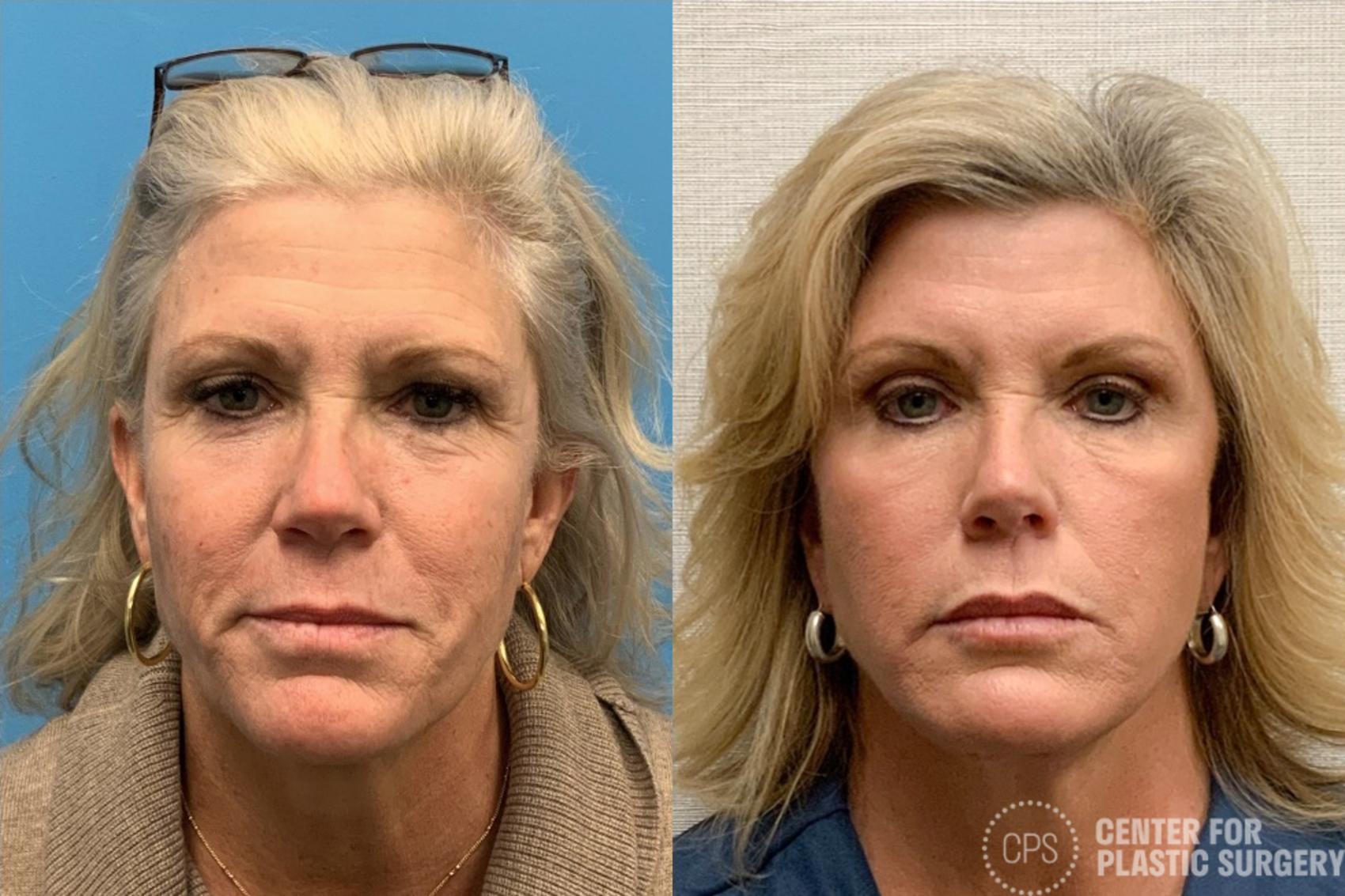 Facelift Case 420 Before & After Front | Chevy Chase & Annandale, Washington D.C. Metropolitan Area | Center for Plastic Surgery
