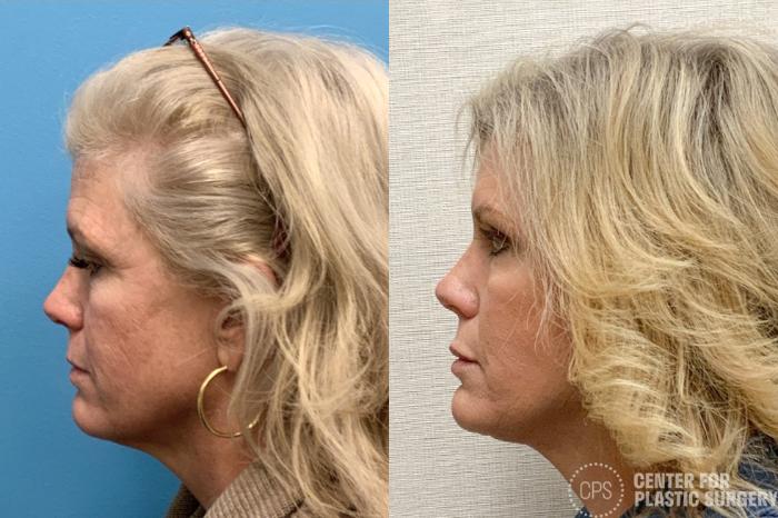 Neck Lift Case 420 Before & After Left Side | Chevy Chase & Annandale, Washington D.C. Metropolitan Area | Center for Plastic Surgery