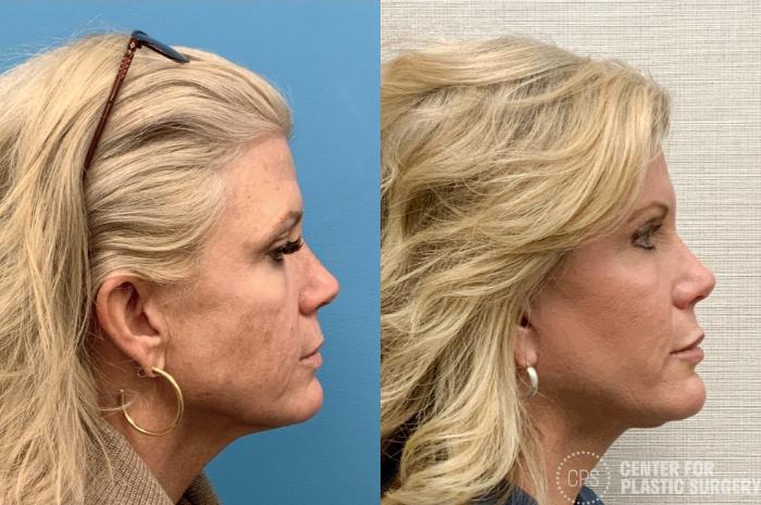 Neck Lift Case 420 Before & After Right Side | Chevy Chase & Annandale, Washington D.C. Metropolitan Area | Center for Plastic Surgery