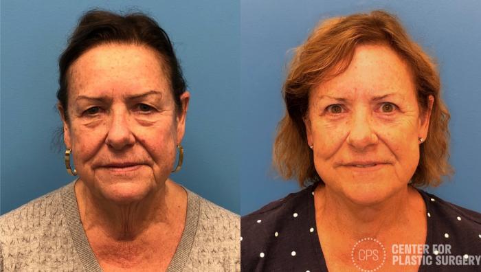 Facelift Case 429 Before & After Front | Chevy Chase & Annandale, Washington D.C. Metropolitan Area | Center for Plastic Surgery
