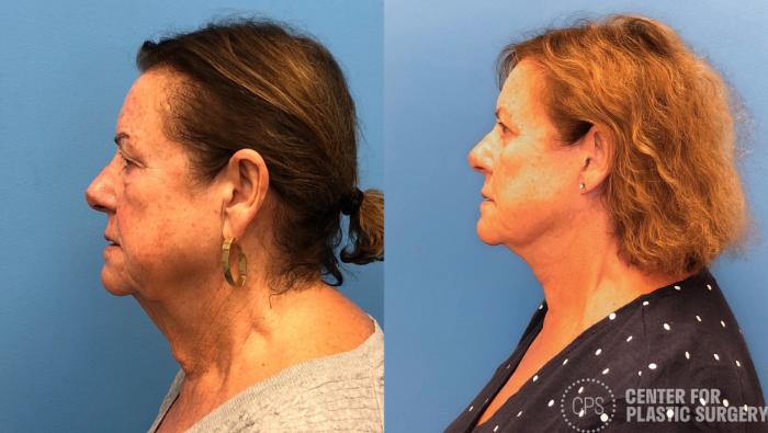 Facelift Case 429 Before & After Left Side | Chevy Chase & Annandale, Washington D.C. Metropolitan Area | Center for Plastic Surgery