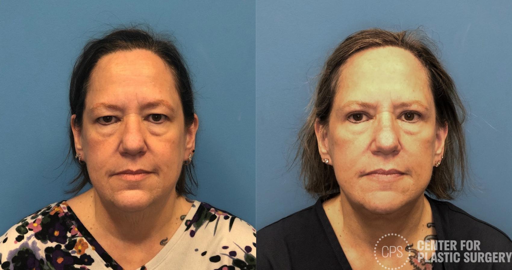 Facelift Case 430 Before & After Front | Chevy Chase & Annandale, Washington D.C. Metropolitan Area | Center for Plastic Surgery