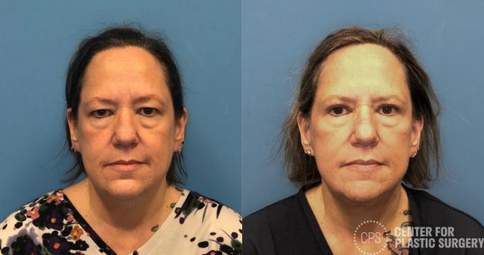 Facelift Case 430 Before & After Front | Chevy Chase & Annandale, Washington D.C. Metropolitan Area | Center for Plastic Surgery