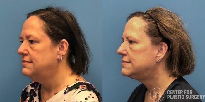 Eyelid Surgery Case 430 Before & After Left Oblique | Chevy Chase & Annandale, Washington D.C. Metropolitan Area | Center for Plastic Surgery
