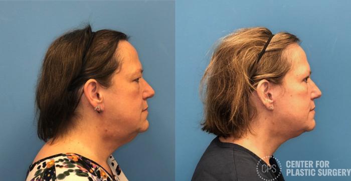 Facelift Case 430 Before & After Right Side | Chevy Chase & Annandale, Washington D.C. Metropolitan Area | Center for Plastic Surgery