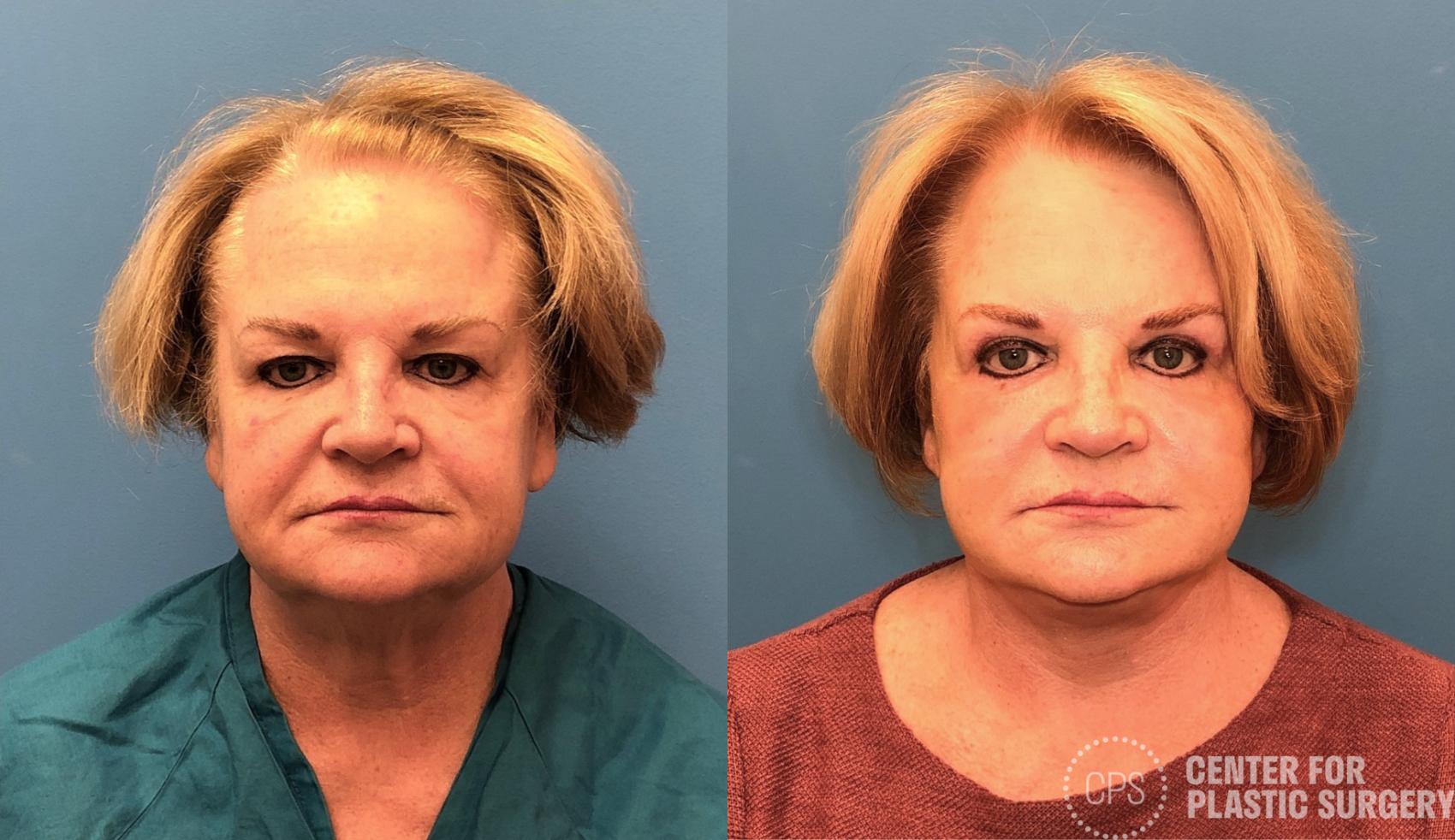 Facelift Case 431 Before & After Front | Chevy Chase & Annandale, Washington D.C. Metropolitan Area | Center for Plastic Surgery