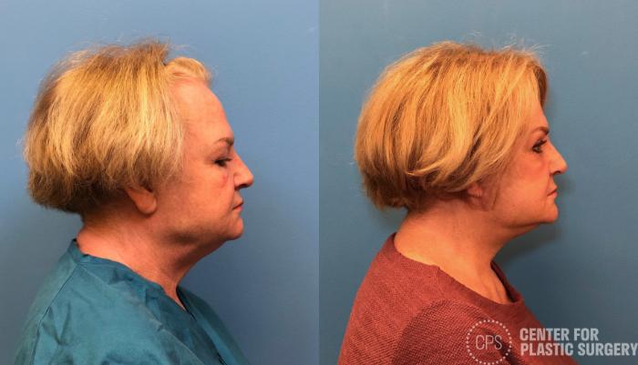 Facelift Case 431 Before & After Right Side | Chevy Chase & Annandale, Washington D.C. Metropolitan Area | Center for Plastic Surgery