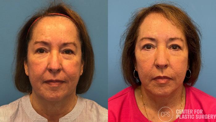 Facelift Case 432 Before & After Front | Chevy Chase & Annandale, Washington D.C. Metropolitan Area | Center for Plastic Surgery