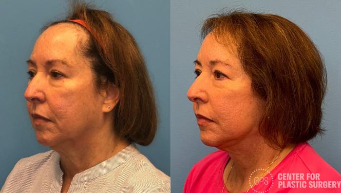 Facelift Case 432 Before & After Left Oblique | Chevy Chase & Annandale, Washington D.C. Metropolitan Area | Center for Plastic Surgery