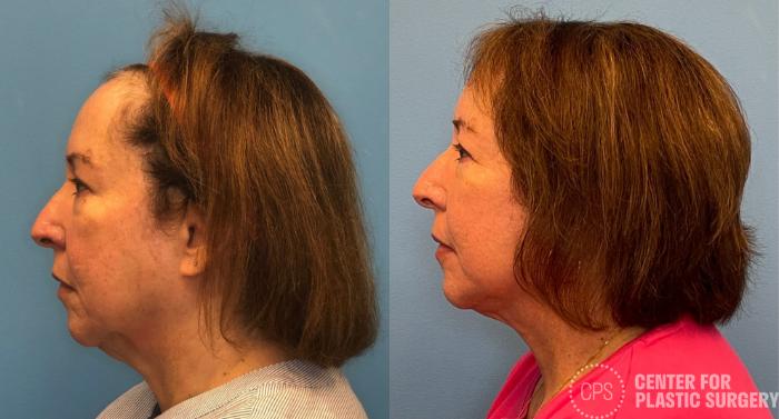 Facelift Case 432 Before & After Left Side | Chevy Chase & Annandale, Washington D.C. Metropolitan Area | Center for Plastic Surgery