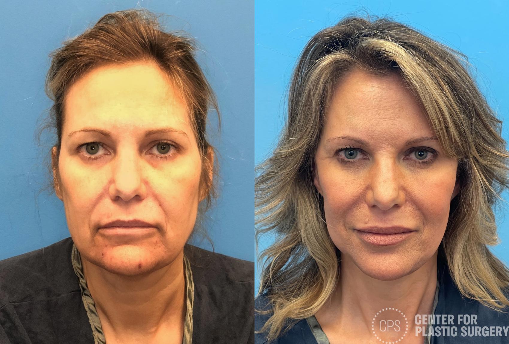 Facelift Case 433 Before & After Front | Chevy Chase & Annandale, Washington D.C. Metropolitan Area | Center for Plastic Surgery
