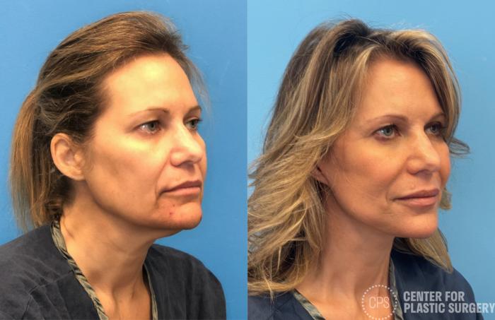 Facelift Case 433 Before & After Right Oblique | Chevy Chase & Annandale, Washington D.C. Metropolitan Area | Center for Plastic Surgery