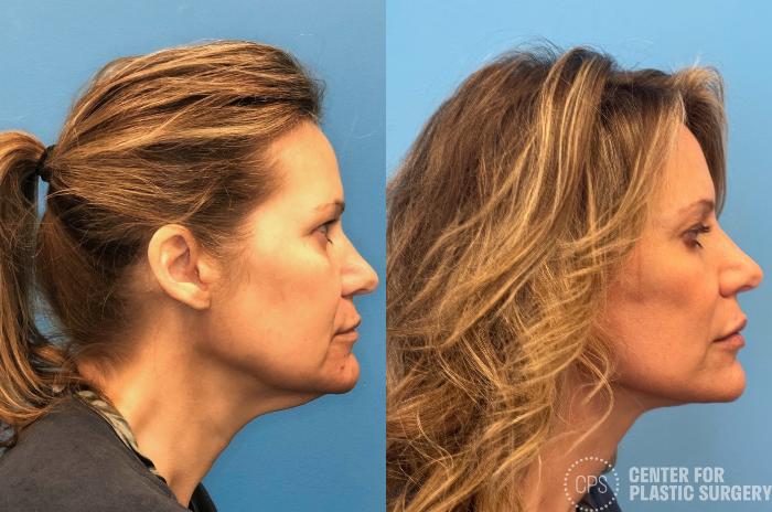 Facelift Case 433 Before & After Right Side | Chevy Chase & Annandale, Washington D.C. Metropolitan Area | Center for Plastic Surgery