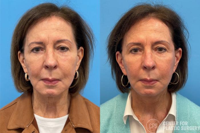 Facelift Case 434 Before & After Front | Chevy Chase & Annandale, Washington D.C. Metropolitan Area | Center for Plastic Surgery