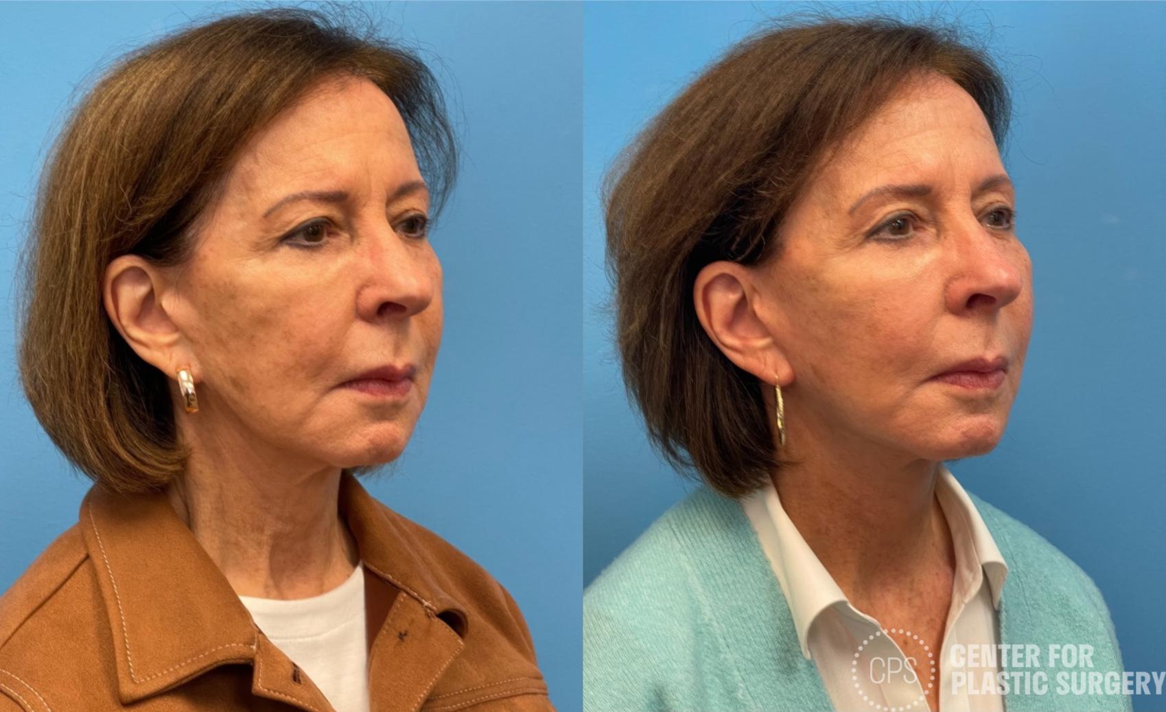 Facelift Case 434 Before & After Right Oblique | Chevy Chase & Annandale, Washington D.C. Metropolitan Area | Center for Plastic Surgery