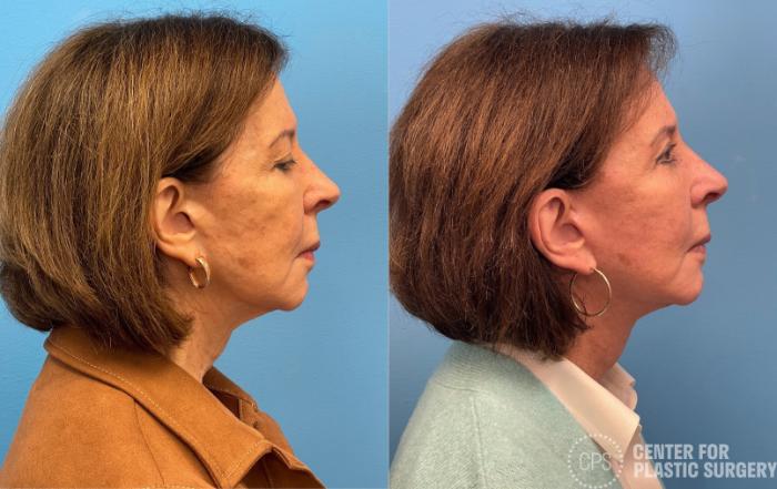 Facelift Case 434 Before & After Right Side | Chevy Chase & Annandale, Washington D.C. Metropolitan Area | Center for Plastic Surgery