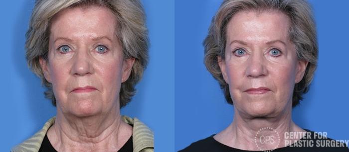 Facelift Case 5 Before & After Front | Chevy Chase & Annandale, Washington D.C. Metropolitan Area | Center for Plastic Surgery