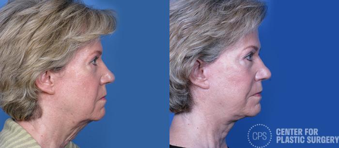 Facelift Case 5 Before & After Right Side | Chevy Chase & Annandale, Washington D.C. Metropolitan Area | Center for Plastic Surgery