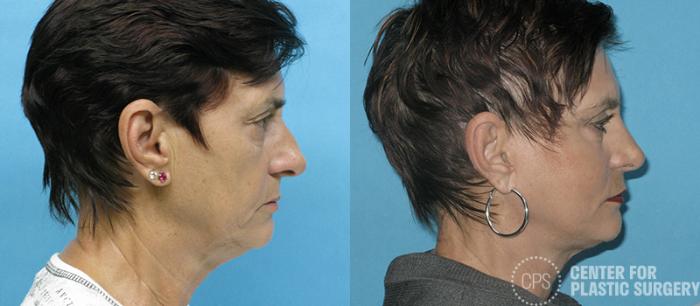 Facelift Case 6 Before & After Front | Chevy Chase & Annandale, Washington D.C. Metropolitan Area | Center for Plastic Surgery