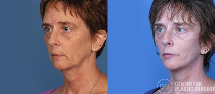 Facelift Case 7 Before & After Left Oblique | Chevy Chase & Annandale, Washington D.C. Metropolitan Area | Center for Plastic Surgery