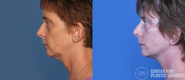 Neck Lift Case 7 Before & After Left Side | Chevy Chase & Annandale, Washington D.C. Metropolitan Area | Center for Plastic Surgery