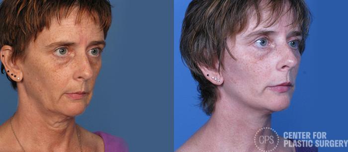 Facelift Case 7 Before & After Right Oblique | Chevy Chase & Annandale, Washington D.C. Metropolitan Area | Center for Plastic Surgery