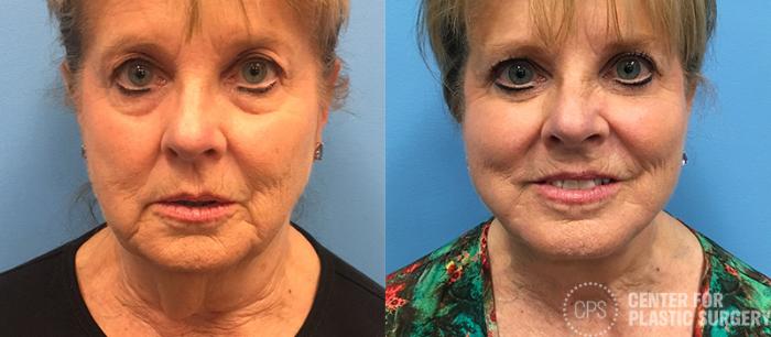 Facelift Case 9 Before & After Front | Chevy Chase & Annandale, Washington D.C. Metropolitan Area | Center for Plastic Surgery
