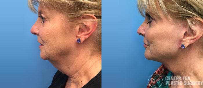 Facelift Case 9 Before & After Left Side | Chevy Chase & Annandale, Washington D.C. Metropolitan Area | Center for Plastic Surgery