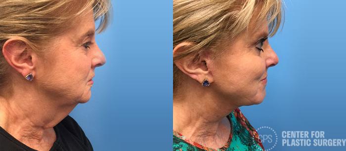 Facelift Case 9 Before & After Right Side | Chevy Chase & Annandale, Washington D.C. Metropolitan Area | Center for Plastic Surgery