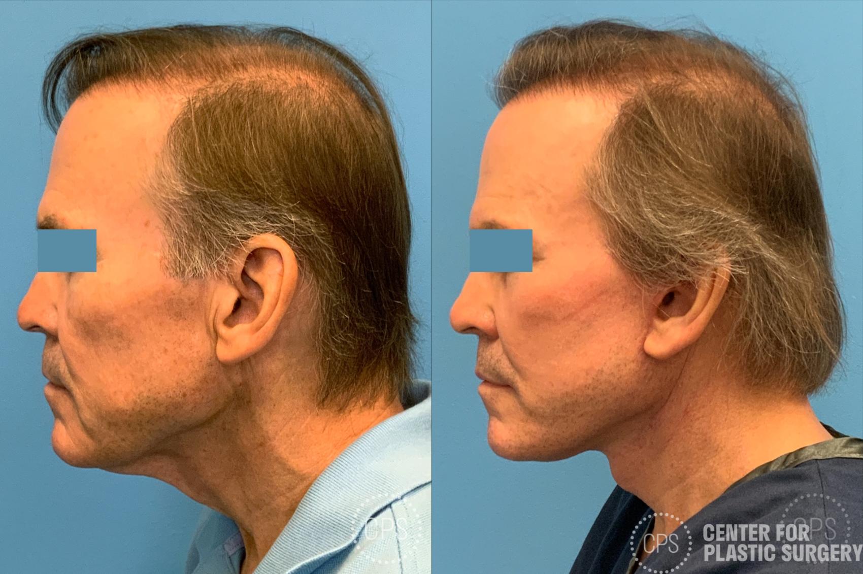 Facelift for Men Case 203 Before & After Left Side | Chevy Chase & Annandale, Washington D.C. Metropolitan Area | Center for Plastic Surgery