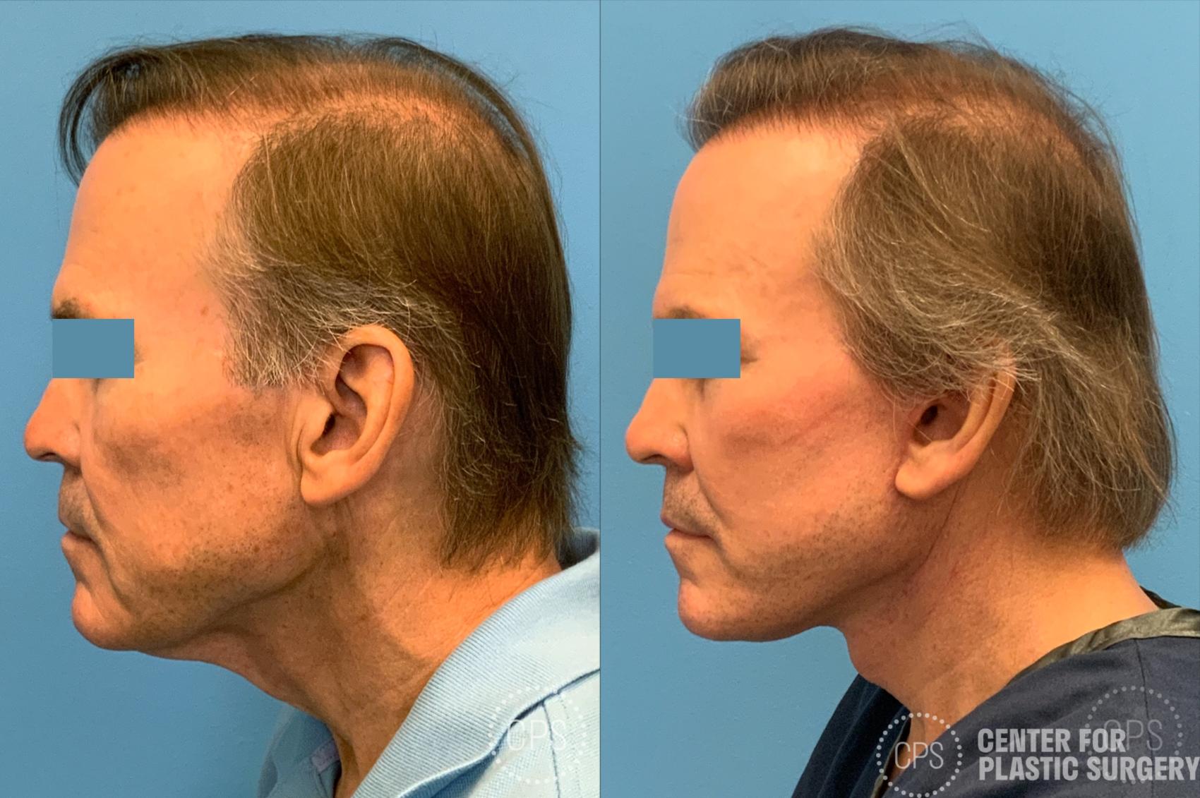 Facelift in Bethesda, MD - Center for Plastic Surgery