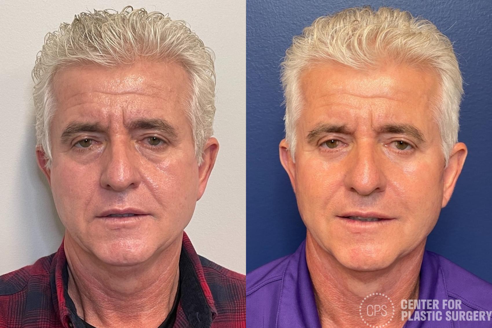 Facelift for Men Case 291 Before & After Front | Chevy Chase & Annandale, Washington D.C. Metropolitan Area | Center for Plastic Surgery