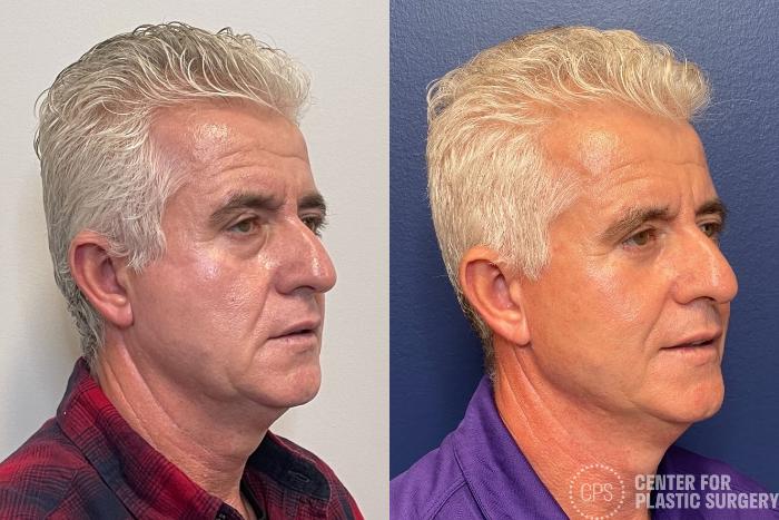 Facelift for Men Case 291 Before & After Right Oblique | Chevy Chase & Annandale, Washington D.C. Metropolitan Area | Center for Plastic Surgery