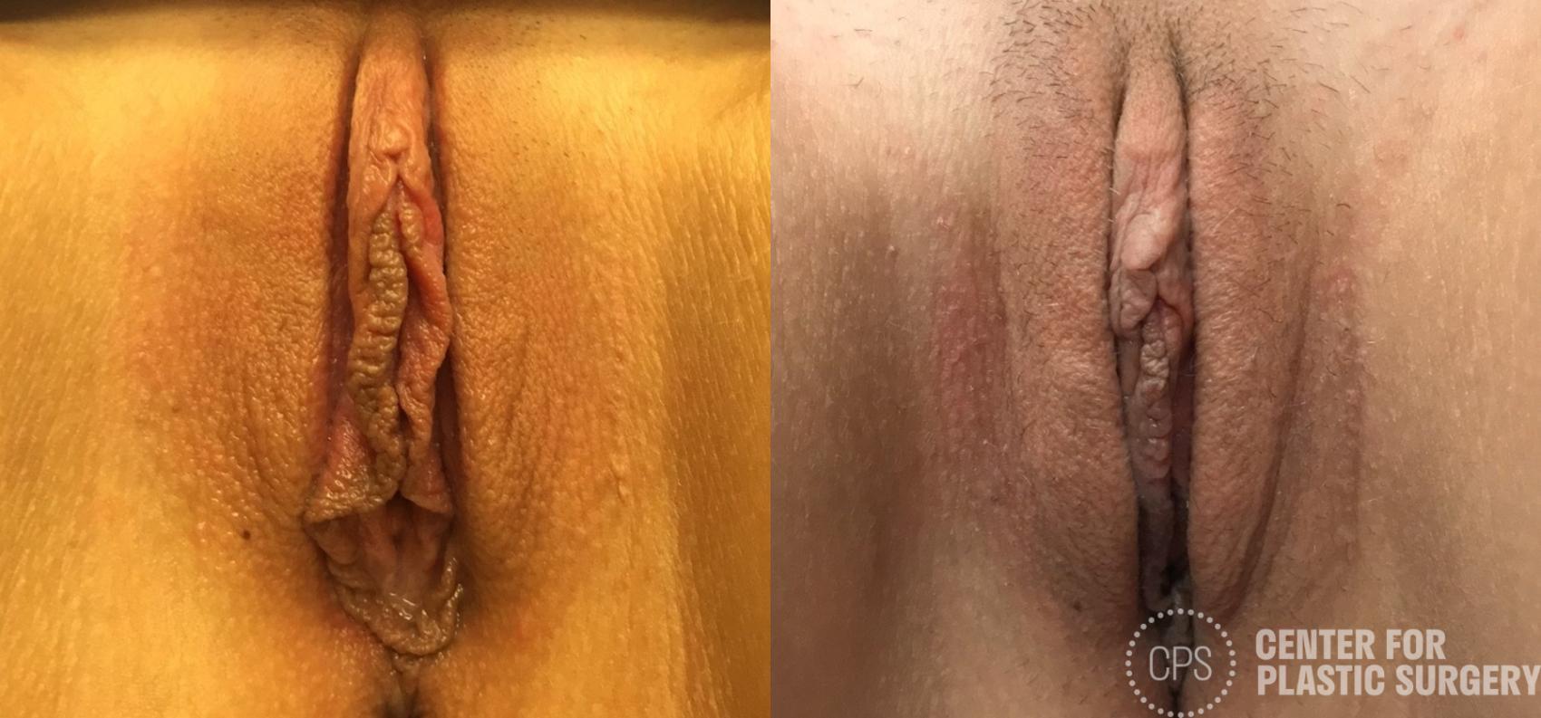 Labiaplasty Case 282 Before & After Front | Chevy Chase & Annandale, Washington D.C. Metropolitan Area | Center for Plastic Surgery