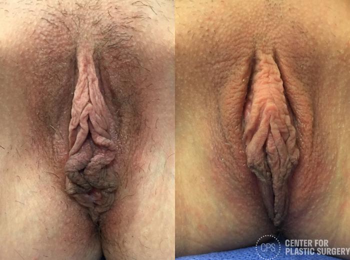 Labiaplasty Case 283 Before & After Front | Chevy Chase & Annandale, Washington D.C. Metropolitan Area | Center for Plastic Surgery