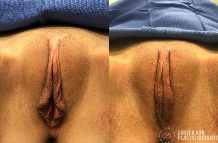 Labiaplasty Case 45 Before & After Front | Chevy Chase & Annandale, Washington D.C. Metropolitan Area | Center for Plastic Surgery