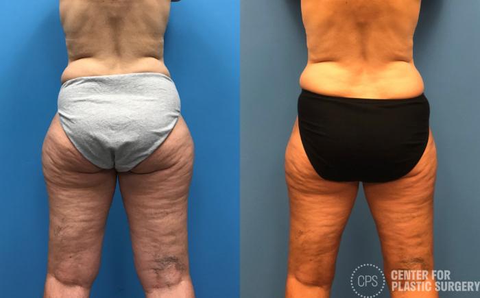 Liposuction Case 152 Before & After Back | Chevy Chase & Annandale, Washington D.C. Metropolitan Area | Center for Plastic Surgery