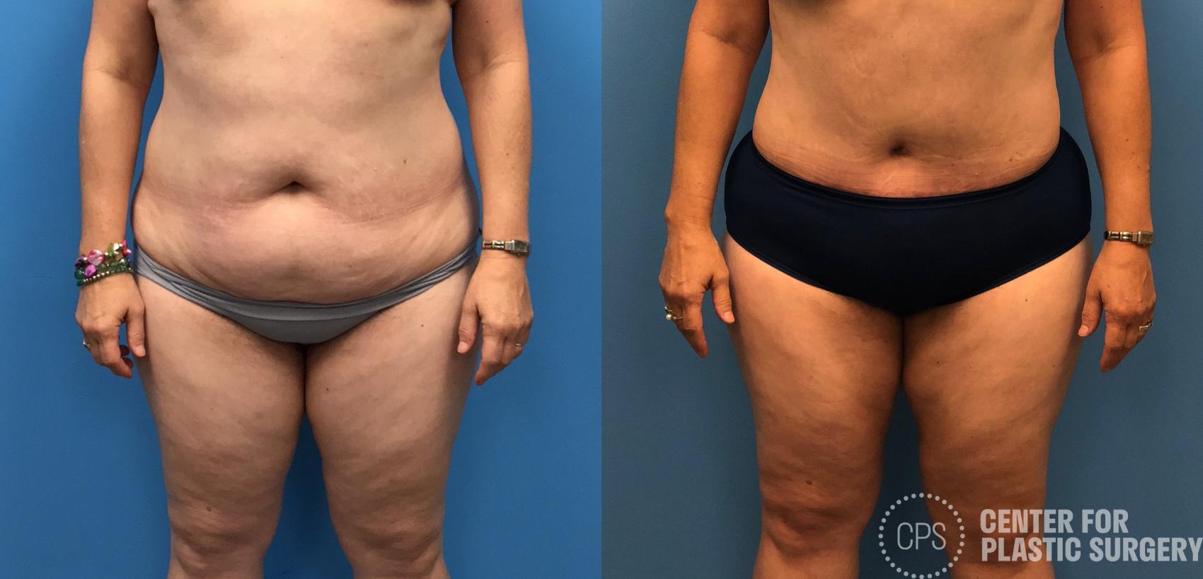 Liposuction Case 158 Before & After Front | Chevy Chase & Annandale, Washington D.C. Metropolitan Area | Center for Plastic Surgery