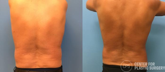 Liposuction Case 161 Before & After Back | Chevy Chase & Annandale, Washington D.C. Metropolitan Area | Center for Plastic Surgery