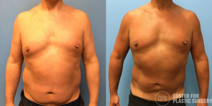 Liposuction Case 161 Before & After Front | Chevy Chase & Annandale, Washington D.C. Metropolitan Area | Center for Plastic Surgery