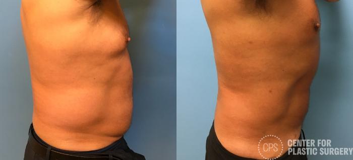 Liposuction Case 161 Before & After Right Side | Chevy Chase & Annandale, Washington D.C. Metropolitan Area | Center for Plastic Surgery