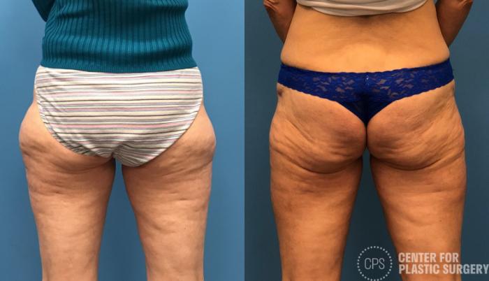Liposuction Case 163 Before & After Back | Chevy Chase & Annandale, Washington D.C. Metropolitan Area | Center for Plastic Surgery
