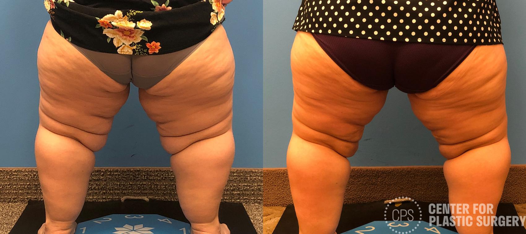 Liposuction Case 166 Before & After Back | Annandale, Washington D.C. Metropolitan Area | Center for Plastic Surgery