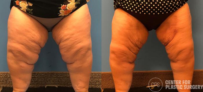 Liposuction Case 166 Before & After Front | Chevy Chase & Annandale, Washington D.C. Metropolitan Area | Center for Plastic Surgery