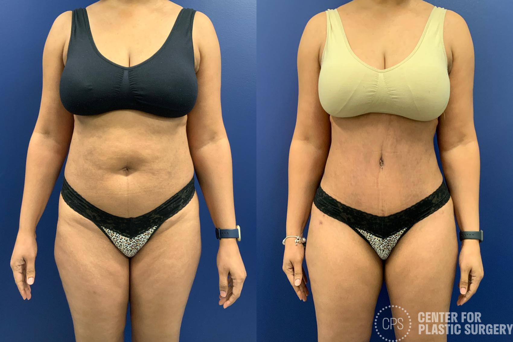 Liposuction Case 196 Before & After Front | Chevy Chase & Annandale, Washington D.C. Metropolitan Area | Center for Plastic Surgery